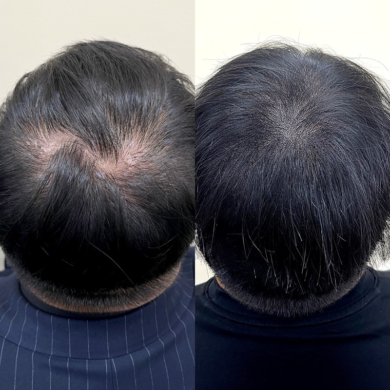 남성 정수리 두피문신 시술 전후 비교 — 정수리 비어 보이던 부위가 채워진 모습