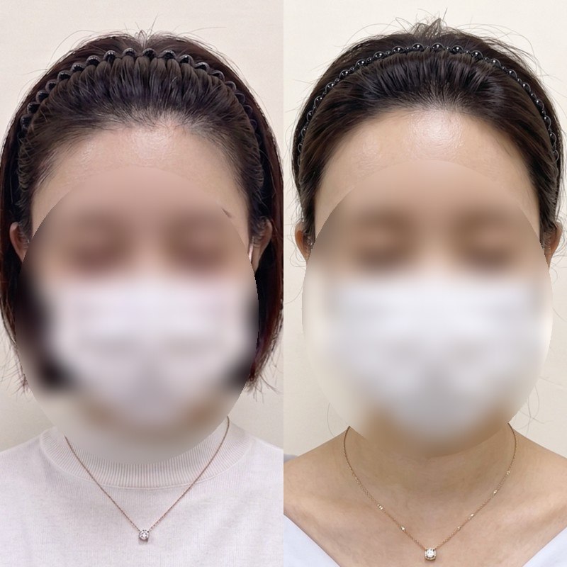 여성 헤어라인 두피문신 시술 전후 비교 — 이마 라인 밀도가 채워진 모습