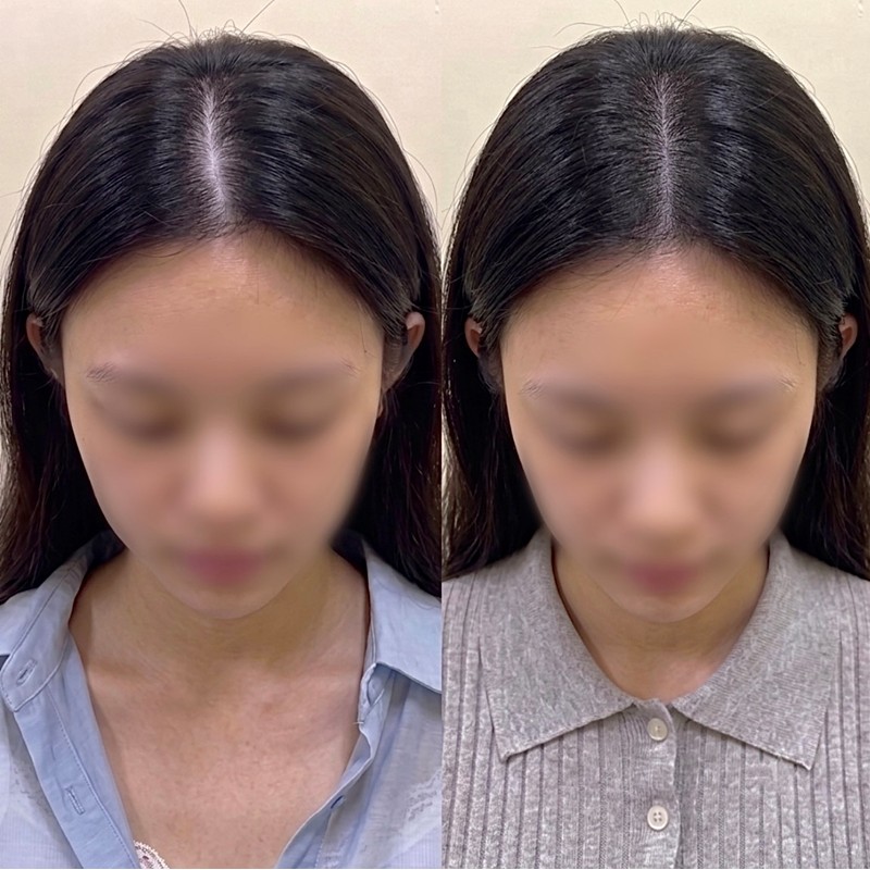 여성 가르마 두피문신 시술 전후 비교 — 가르마 갈라짐이 채워진 모습