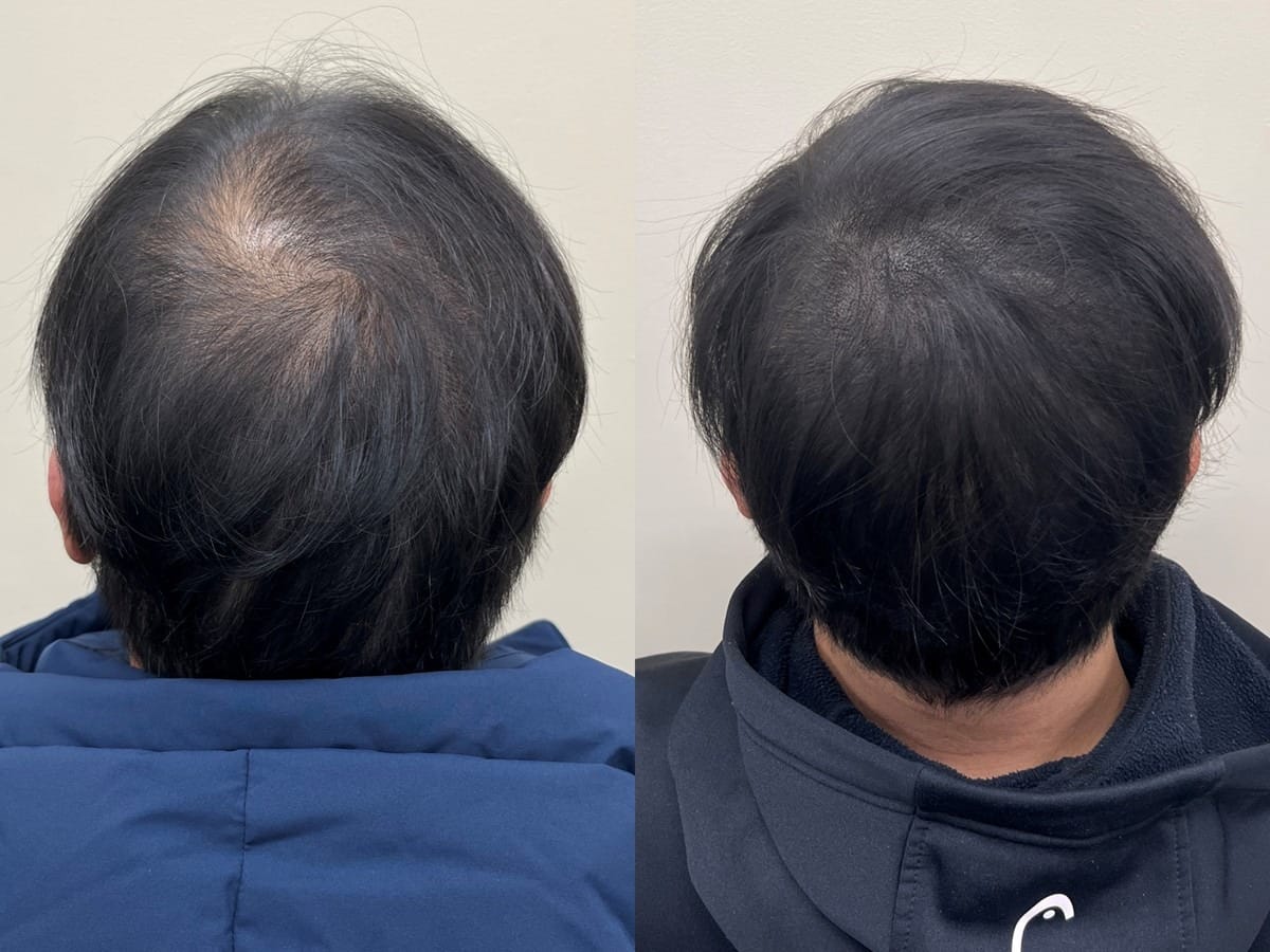 뒤통수 쪽에서 본 남성 정수리, 원형으로 비어 보이던 부분의 두피문신 전후