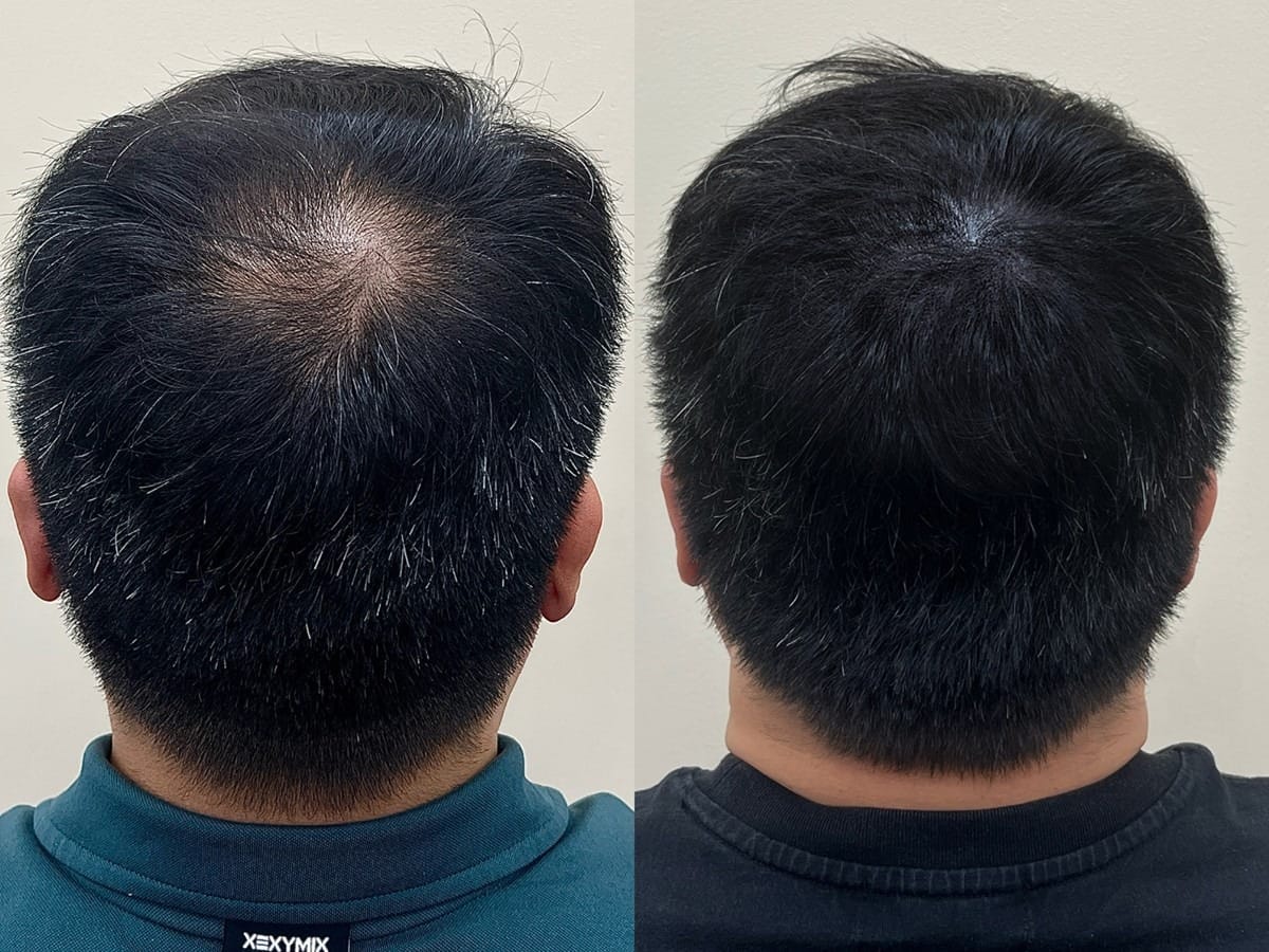 머리를 짧게 자른 남성 정수리, 뒤에서 본 가마 주변 두피문신 전후