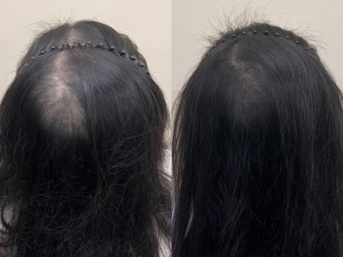 머리를 뒤로 넘긴 여성 정수리, 원형으로 비어 보이던 부분의 두피문신 전후