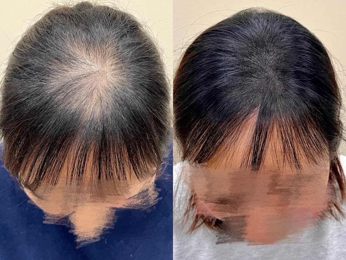 위에서 내려다본 여성 정수리, 가마 중심이 비어 보이던 부분의 두피문신 전후