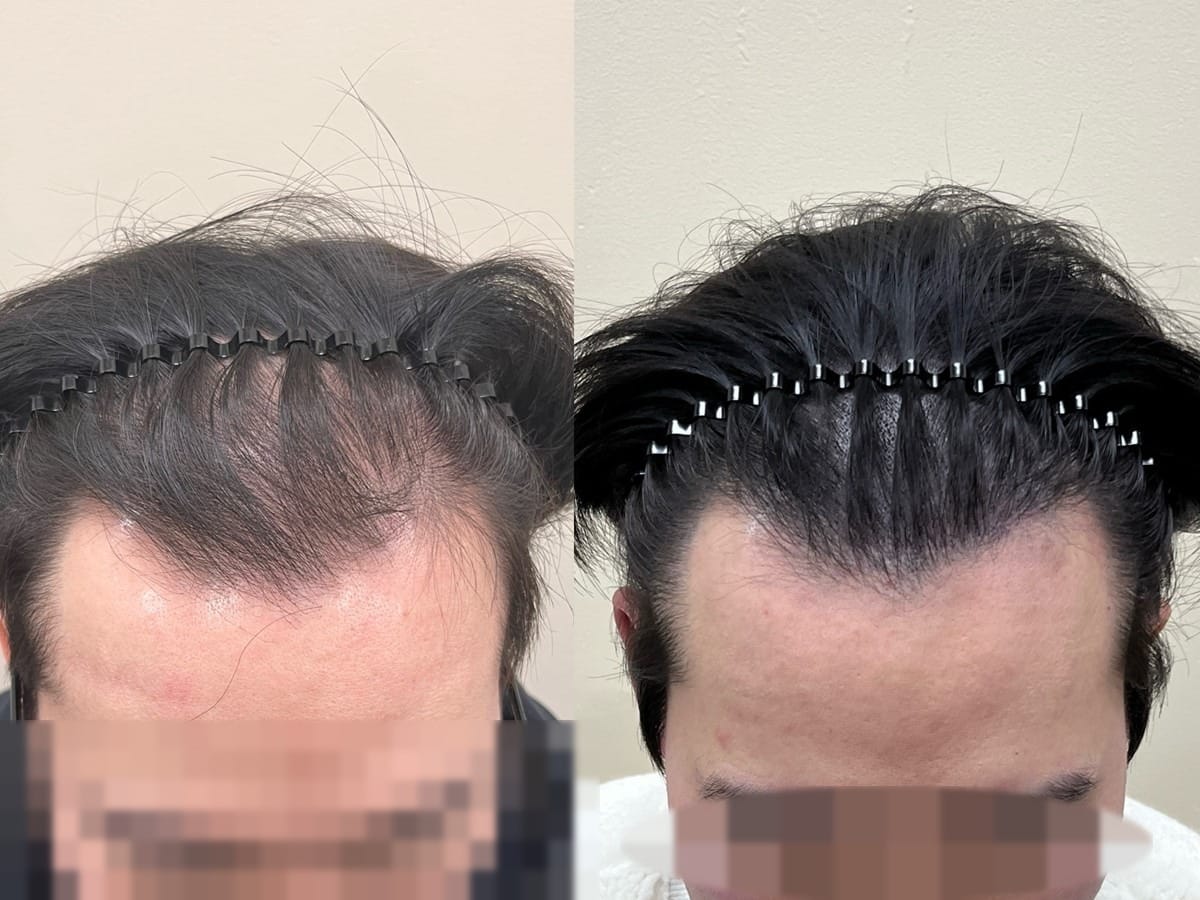 정면에서 본 남성 헤어라인, 앞줄 밀도가 성기고 라인이 뒤로 밀렸던 부위의 두피문신 전후