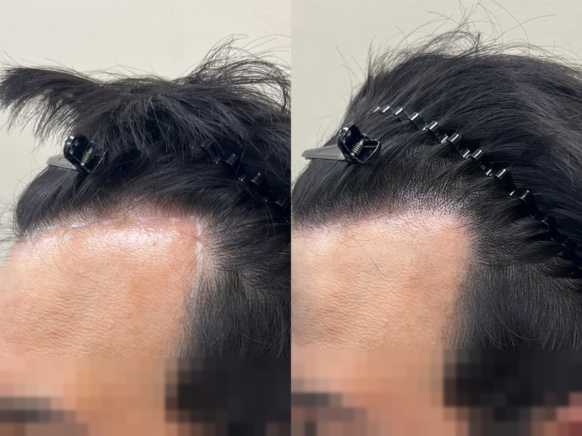 측면 근접에서 본 남성 헤어라인 경계, 이마 쪽으로 물러난 라인을 정돈한 두피문신 전후