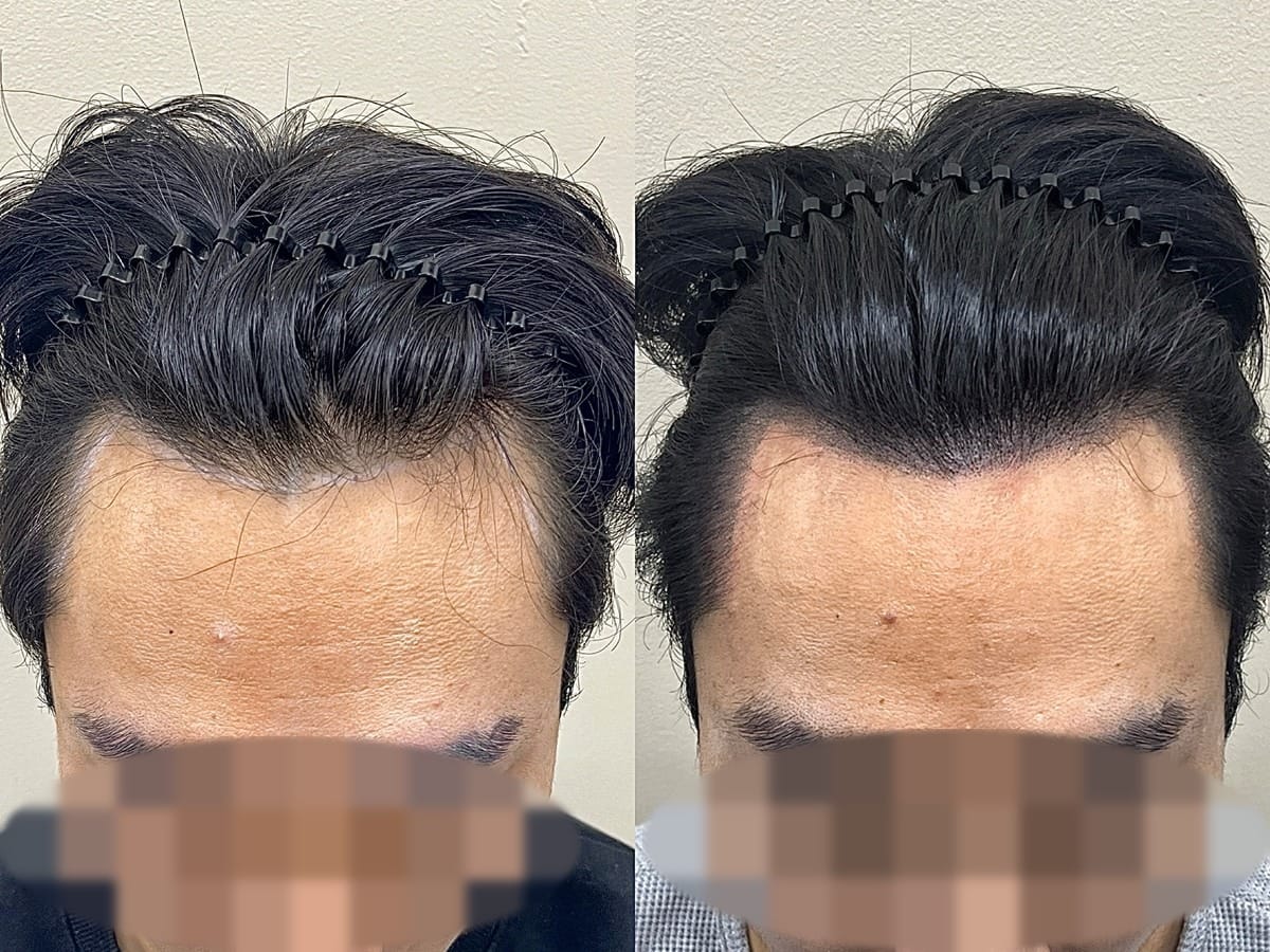 정면에서 본 남성 M자 헤어라인, 양쪽 관자가 깊게 파였던 부위의 두피문신 전후