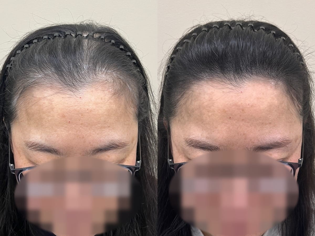정면에서 본 여성 이마, 헤어라인 양옆이 비어 보이던 부위의 두피문신 전후