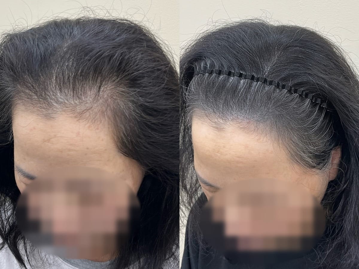 헤어라인 두피문신 시술 전후 비교 - 뒤로 밀려 보이던 이마선이 채워진 모습