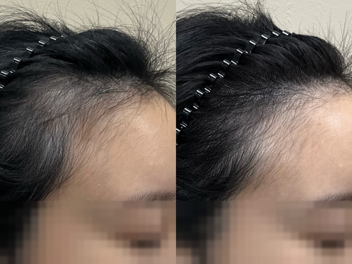 헤어라인 경계를 가까이서 본 근접 사진, 잔머리 구간 두피가 비쳐 보이던 전후
