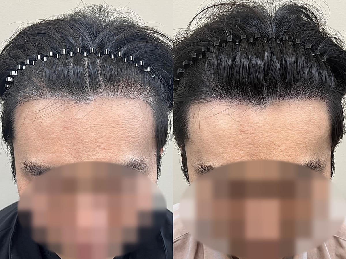 밀도 보강 두피문신 시술 사례