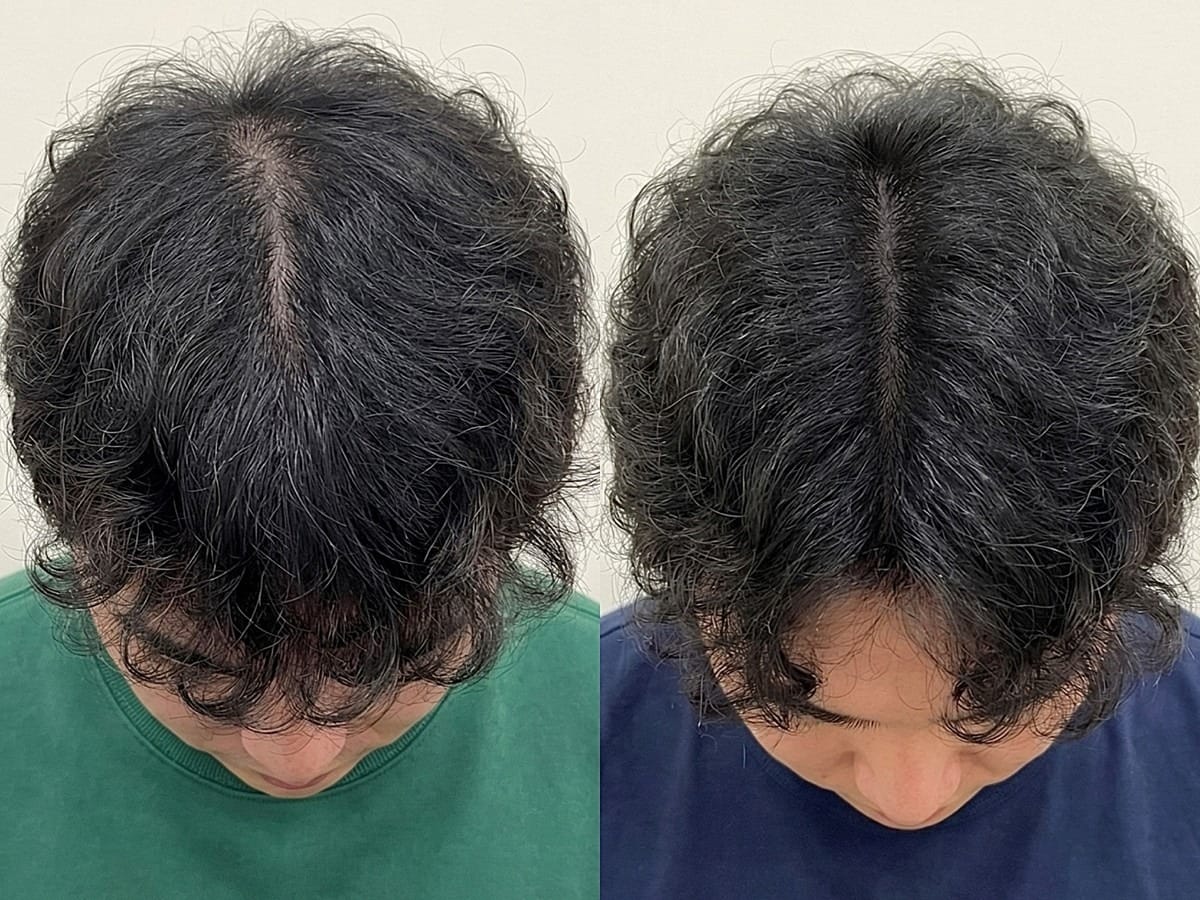 고개 숙인 곱슬머리 남성, 가르마 선을 따라 두피가 드러나던 부위의 두피문신 전후