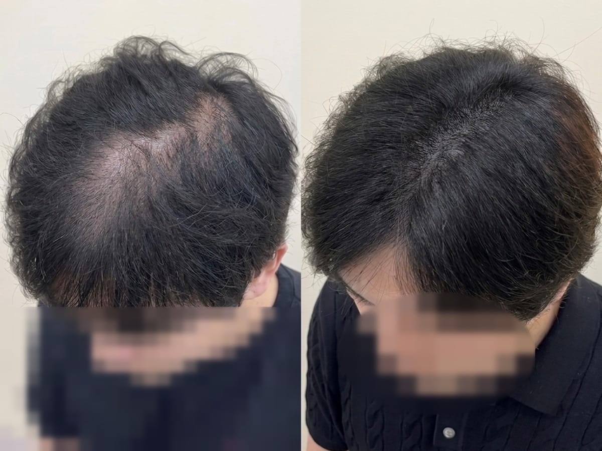 가르마에서 정수리로 이어지는 연결부의 두피 노출을 채운 두피문신 전후