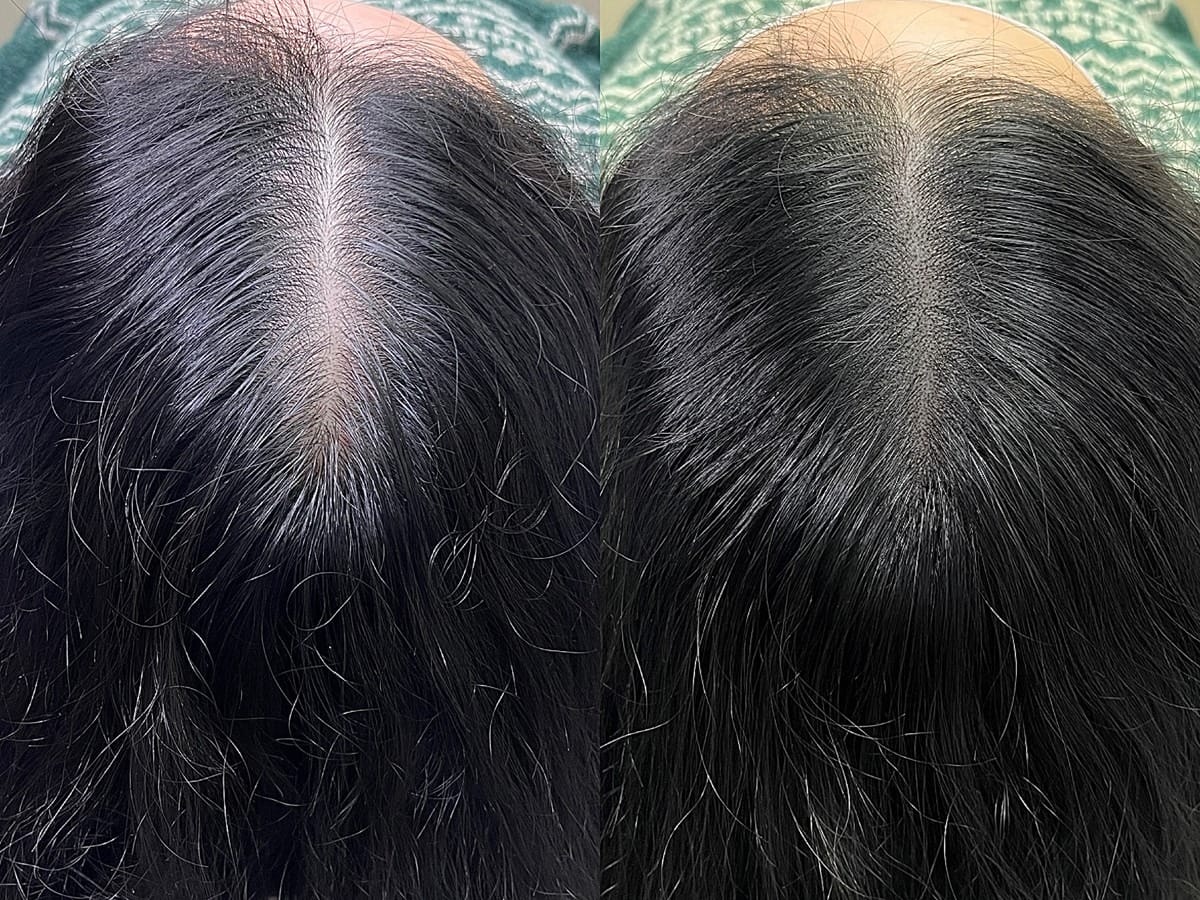 흰머리가 섞여 이마 쪽 가르마 선이 하얗게 비쳐 보이던 부위의 두피문신 전후