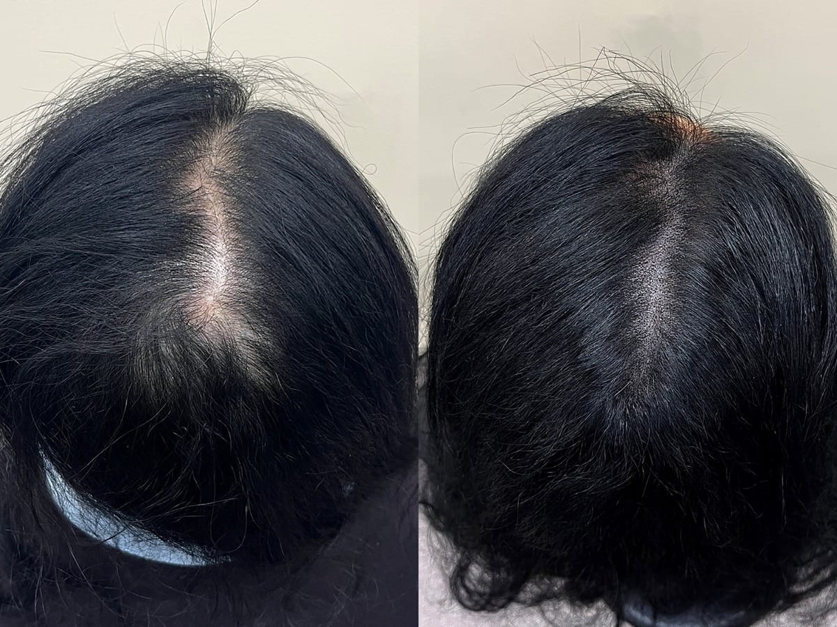 위에서 본 앞쪽 가르마, 선을 따라 두피가 노출되던 여성 가르마의 두피문신 전후