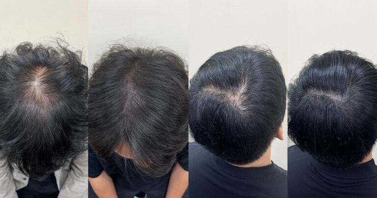 인천두피문신, 좋은 시술을 고르는 체크리스트 3가지