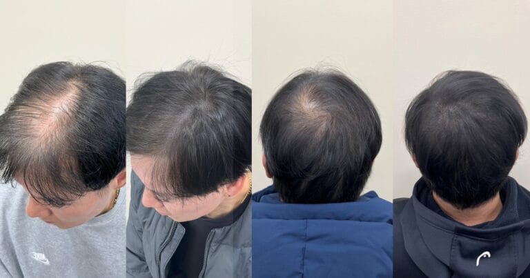 정수리 두피문신 잘하는 곳은 무엇이 다를까요?