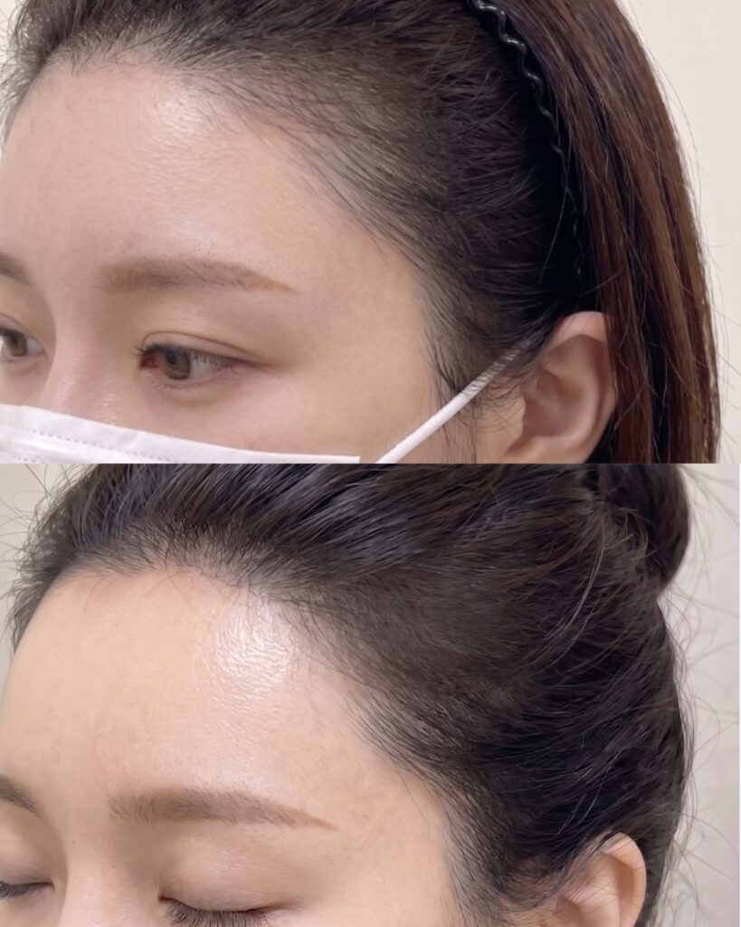 단정하게 정돈한 이마 라인 두피문신 전후