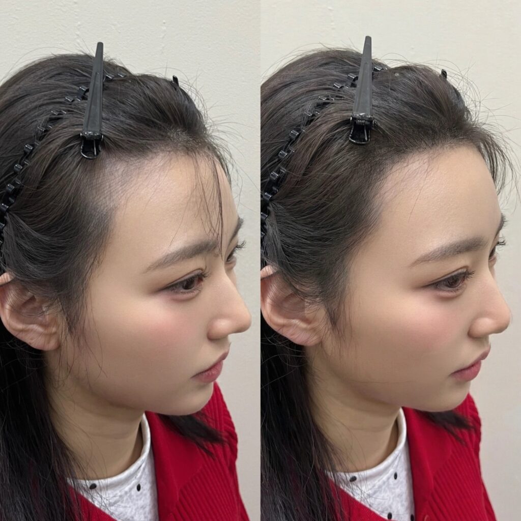 여성 헤어라인 두피문신 시술 전후 비교, 옆모습