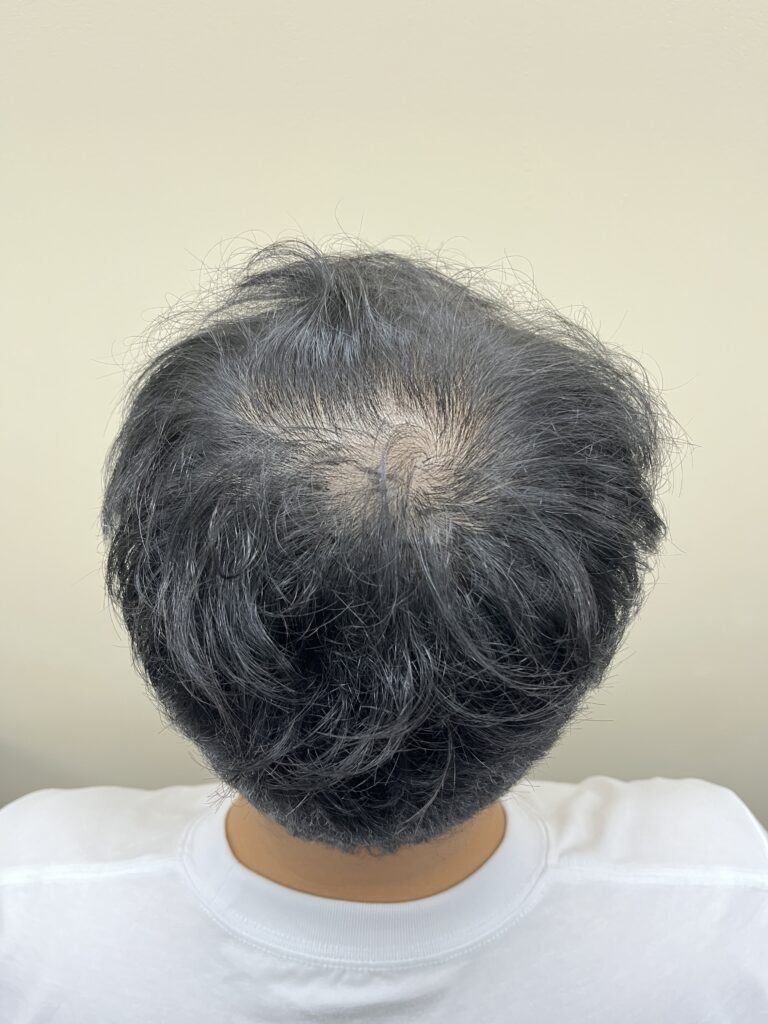 뒤에서 본 정수리, 가마 중심이 드러나 비어 보이는 시술 전 상태