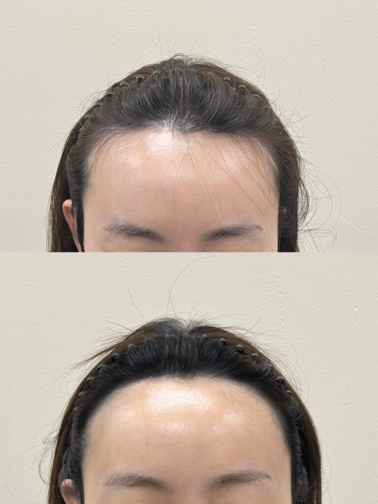 여성 이마 헤어라인 시술 전후 비교, 정면 상단