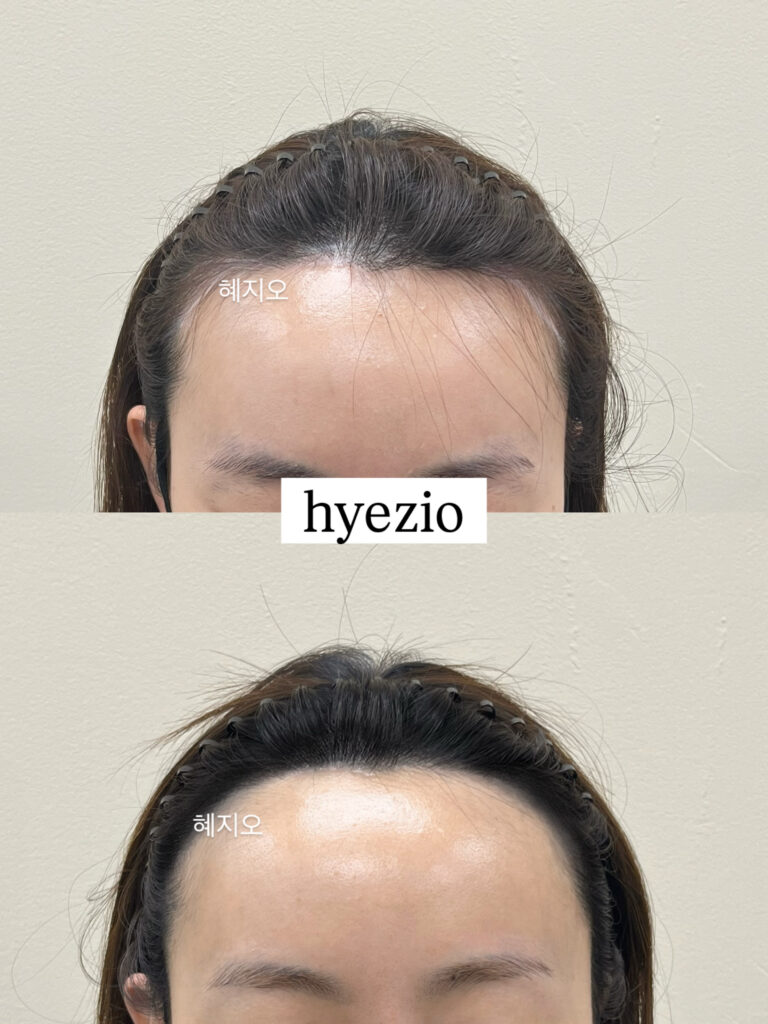 시간이 지난 뒤 헤어라인 두피문신 유지 상태 비교
