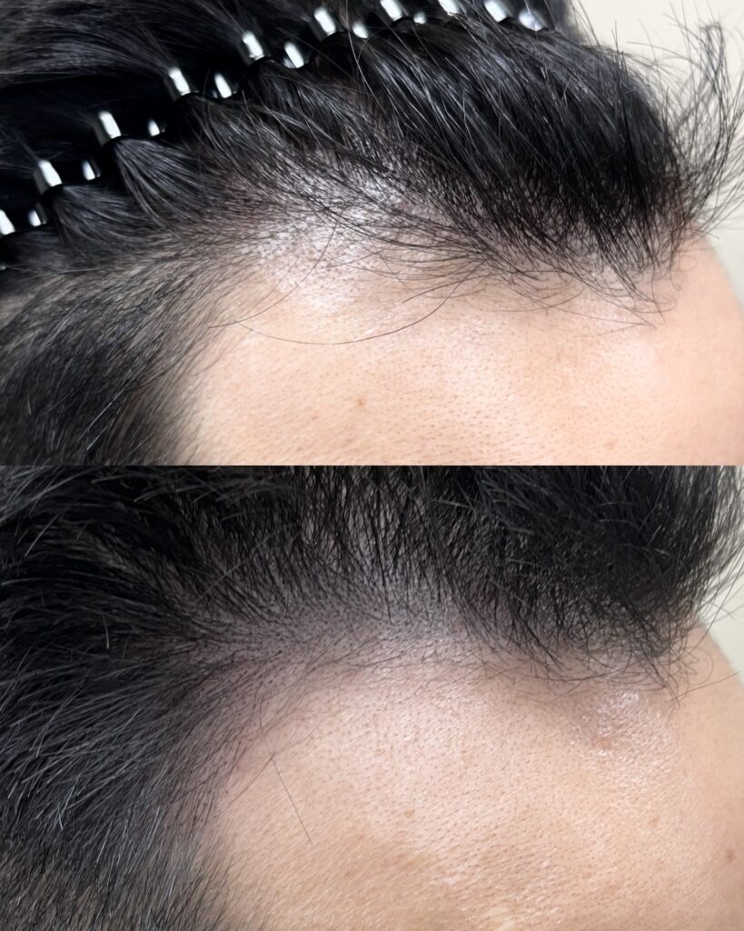 모발이식 부위 밀도를 두피문신으로 보완한 전후