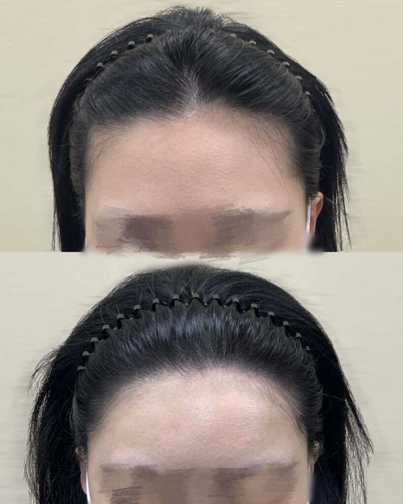 회차를 나눠 정돈한 이마 헤어라인 전후 비교