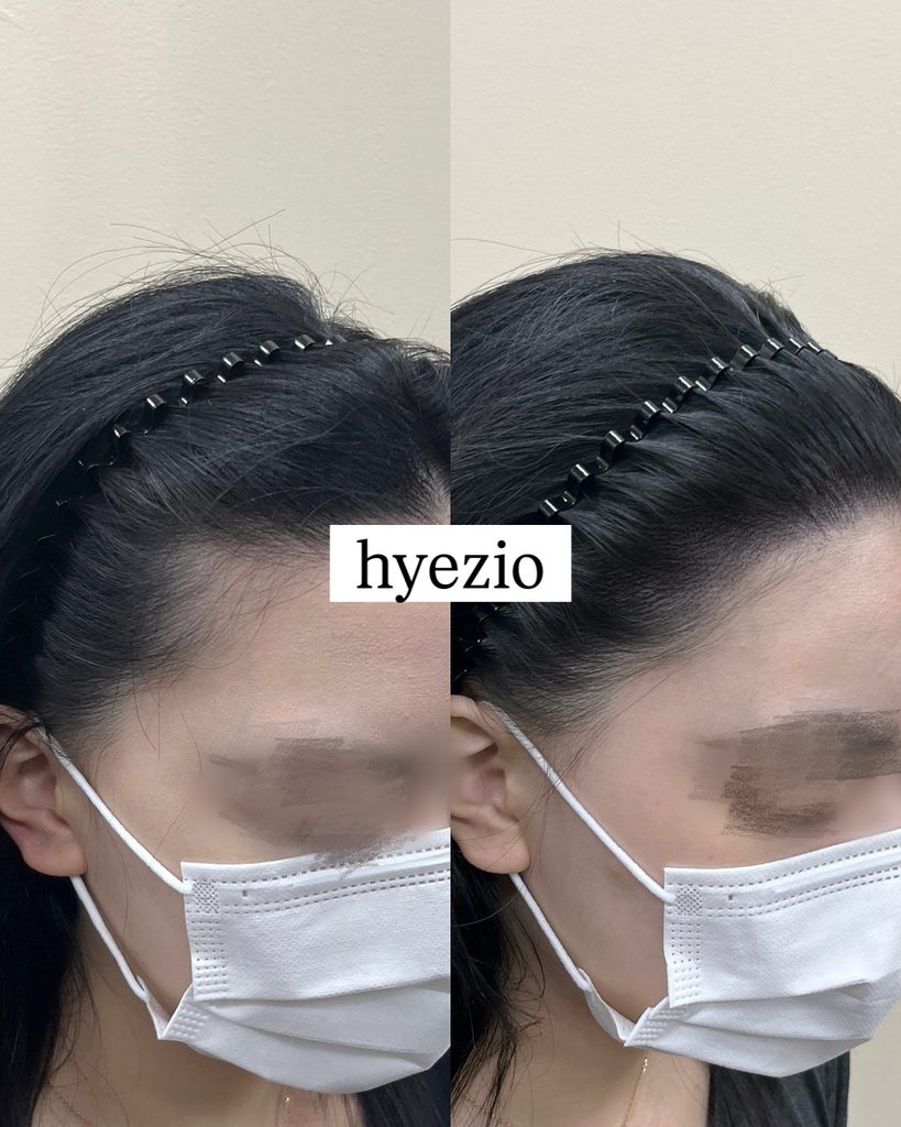 여성 헤어라인반영구 전후 정면 비교, 양옆 이마 라인이 정돈된 모습