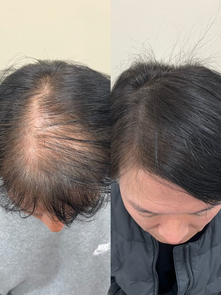회차 사이 간격을 두고 진행한 앞쪽 밀도 변화