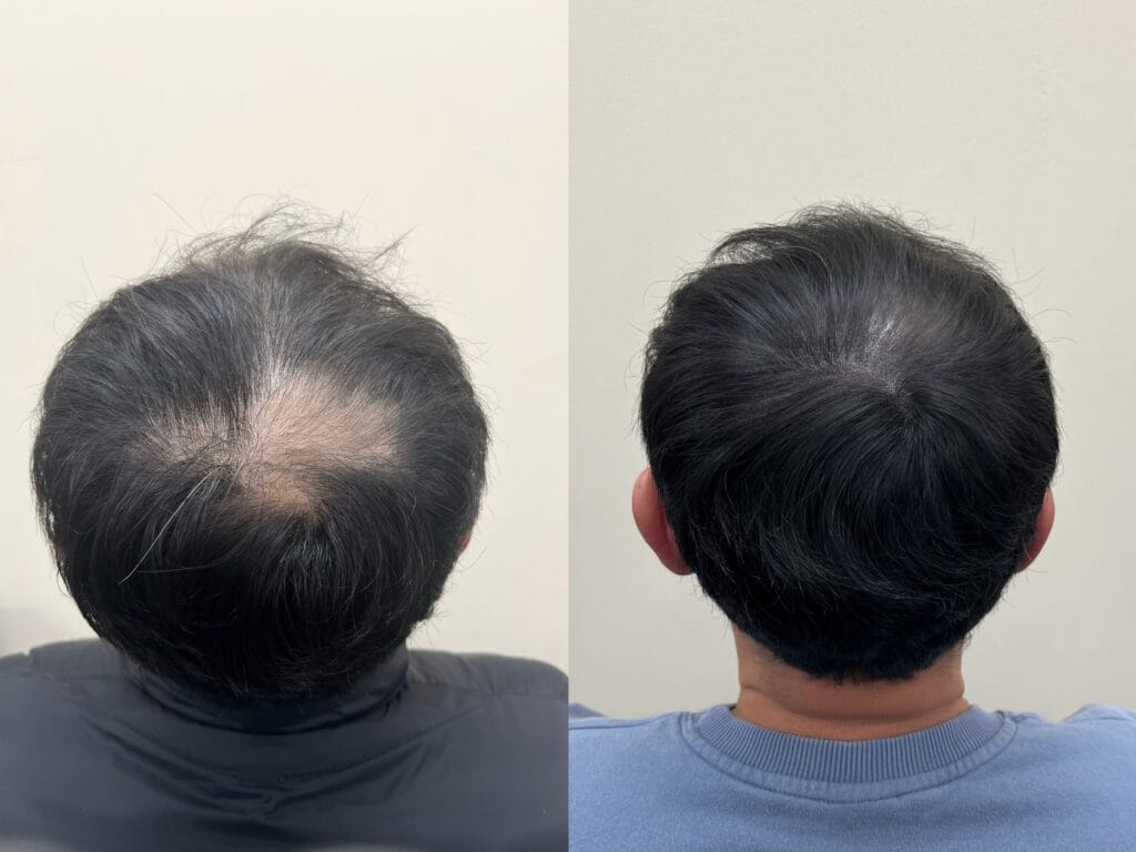 뒤에서 봤을 때 원형으로 비어 보이던 남성 정수리, 두피문신 전후 비교