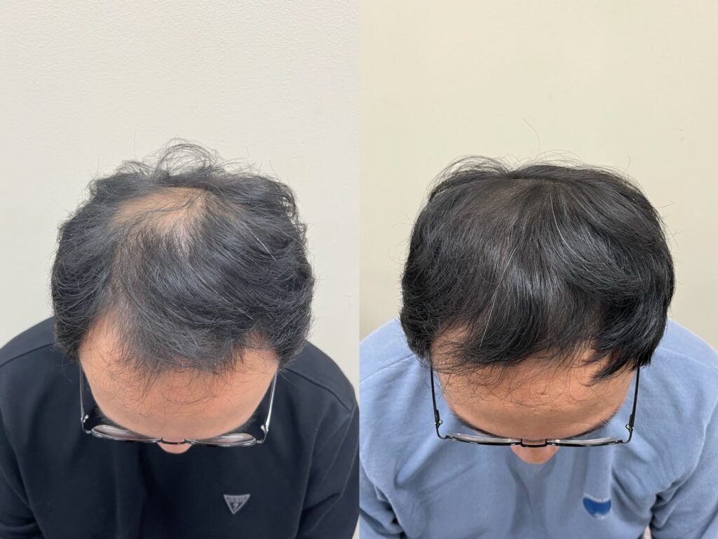 정수리 밀도를 시각적으로 채운 두피문신 전후