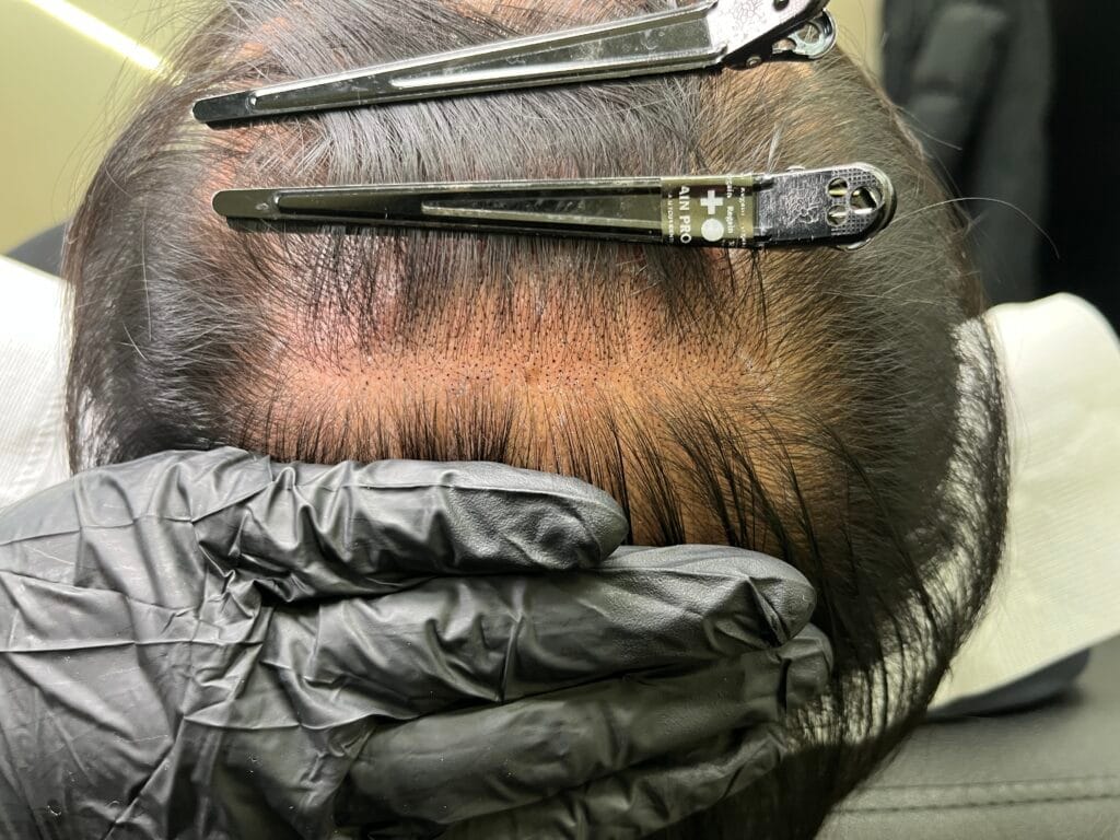 정수리 두피가 드러난 시술 전 상태를 확인하는 모습