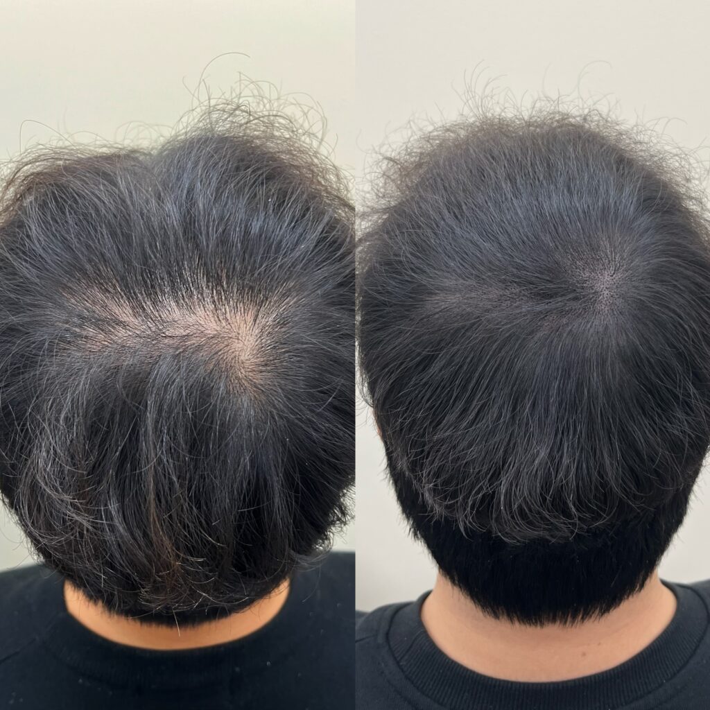 회차를 마친 뒤 뒤에서 확인한 정수리 밀도 변화