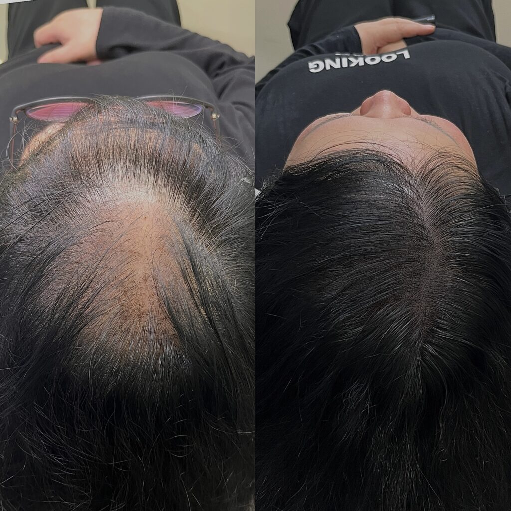 정수리가 비어 보이던 부위의 두피문신 전후