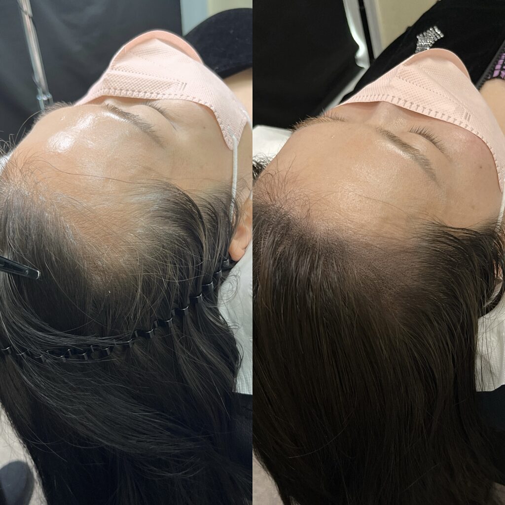 앞머리가 비어 보이던 이마 앞쪽을 채운 시술 전후 비교