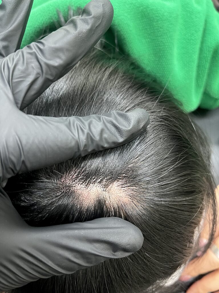 머리카락 사이로 드러난 흉터 자국을 확인하는 모습