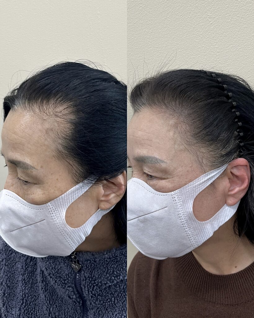 흰머리를 살린 채 밀도만 채운 옆선 전후 비교