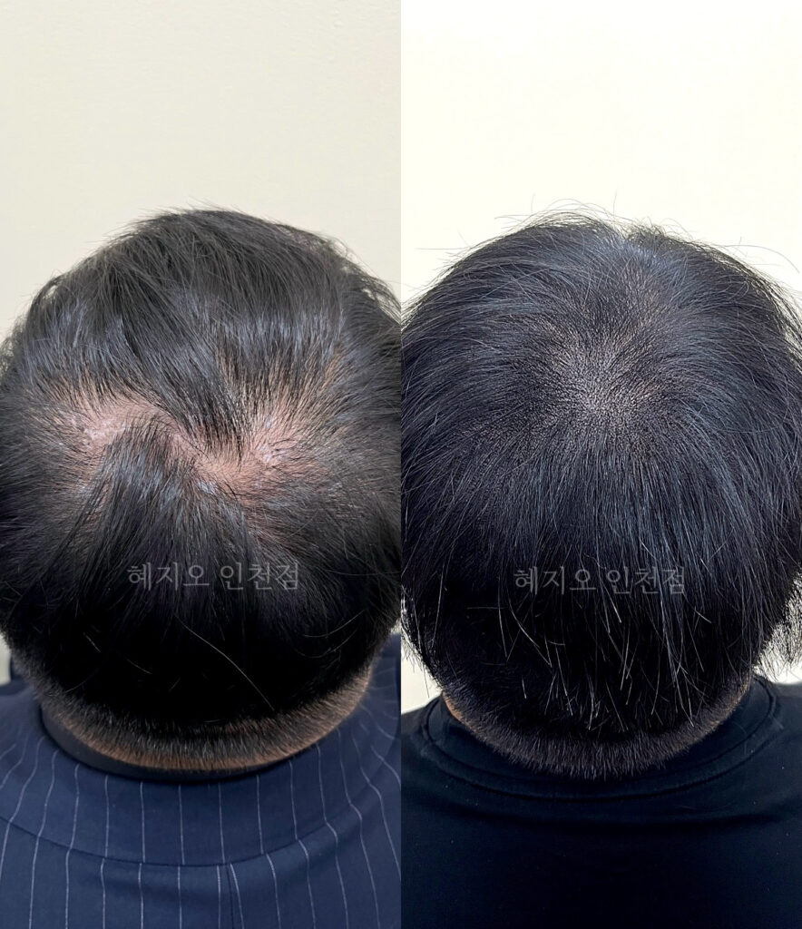 정수리 밀도가 채워진 시술 전후 비교