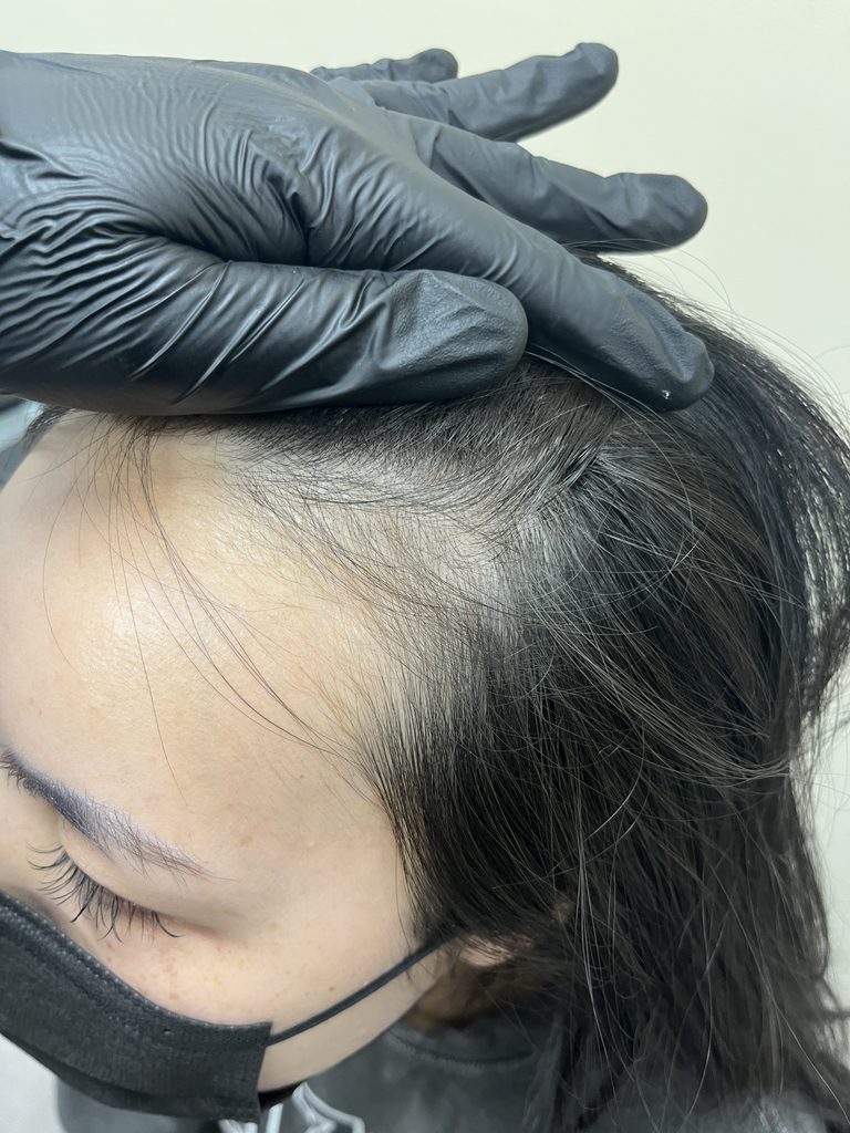 장갑 낀 손으로 머리를 넘겨 확인한 여성 앞머리 헤어라인 근접 사진