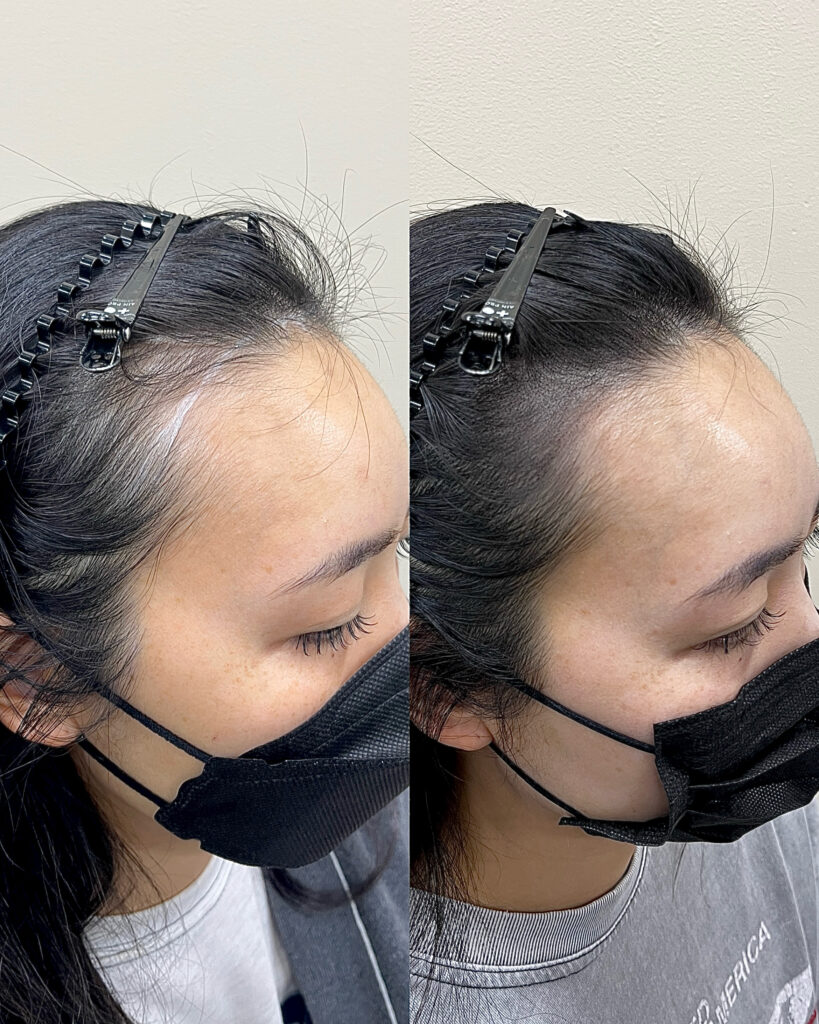 여성 헤어라인 두피문신 시술 전후 비교, 45도 측면