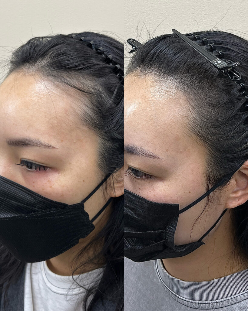 앞머리를 넘겼을 때 드러나는 헤어라인 두피문신 전후