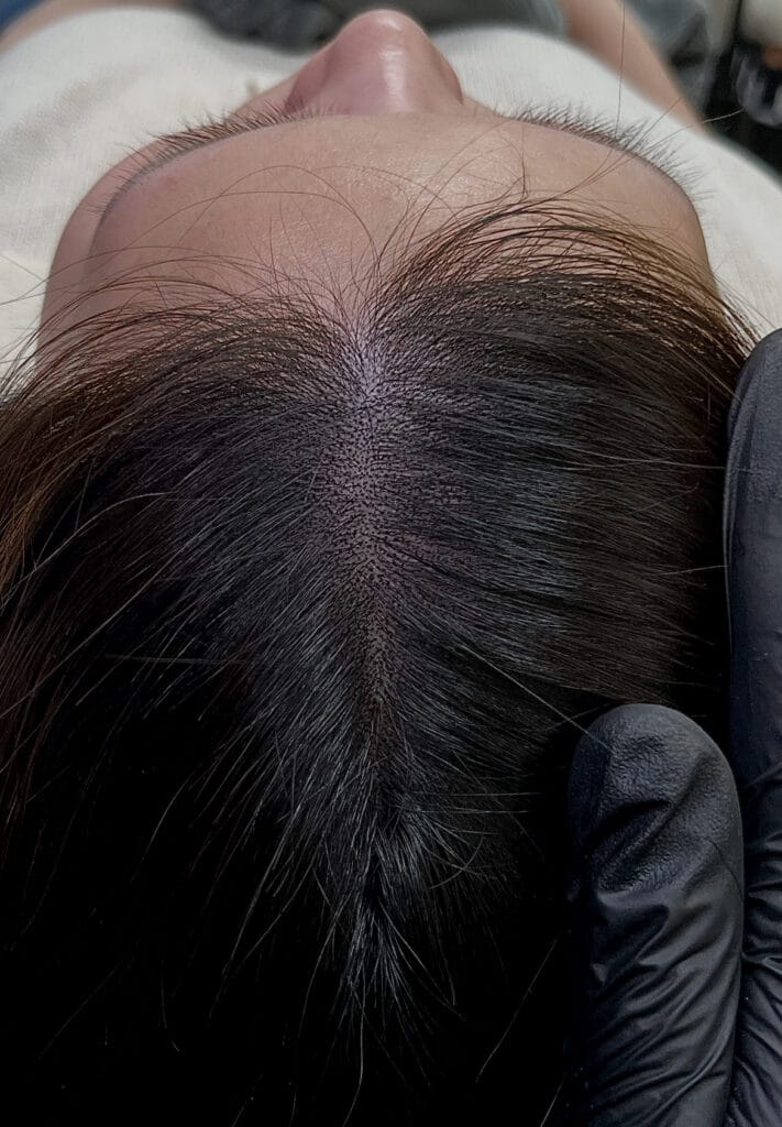 시술 후 여성 가르마 부위 근접 사진, 모발 사이에 심어진 도트