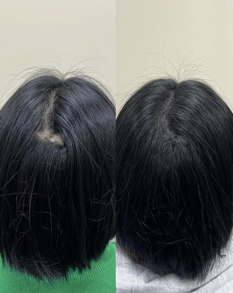 시술 전 상태를 확인하고 진행한 정수리 가르마 전후 비교