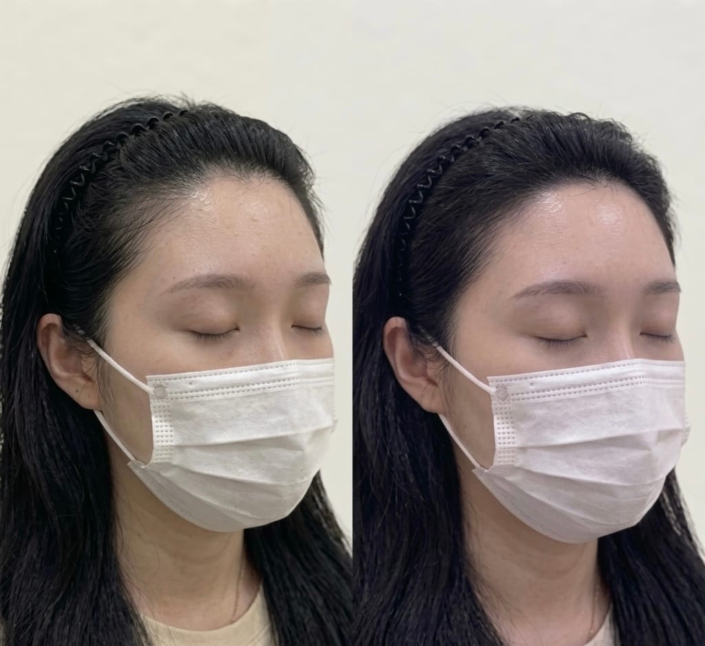 여성 헤어라인 두피문신 시술 전후 비교, 45도 측면