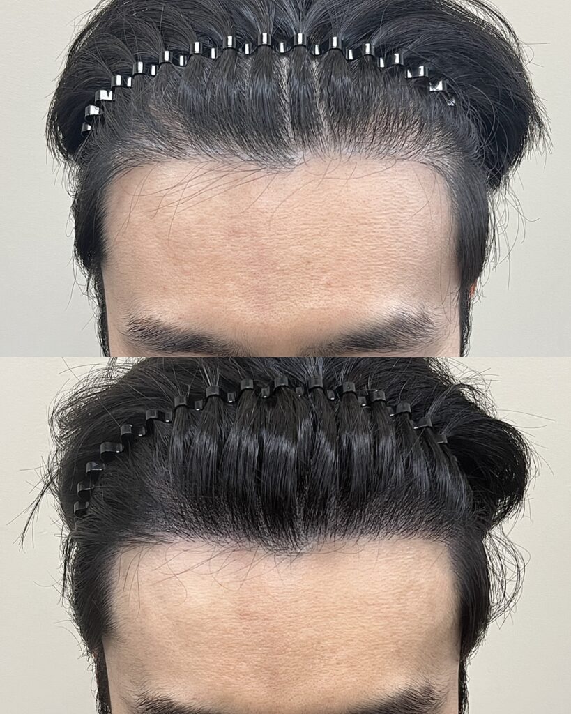 남성 헤어라인 두피문신 시술 전후 비교