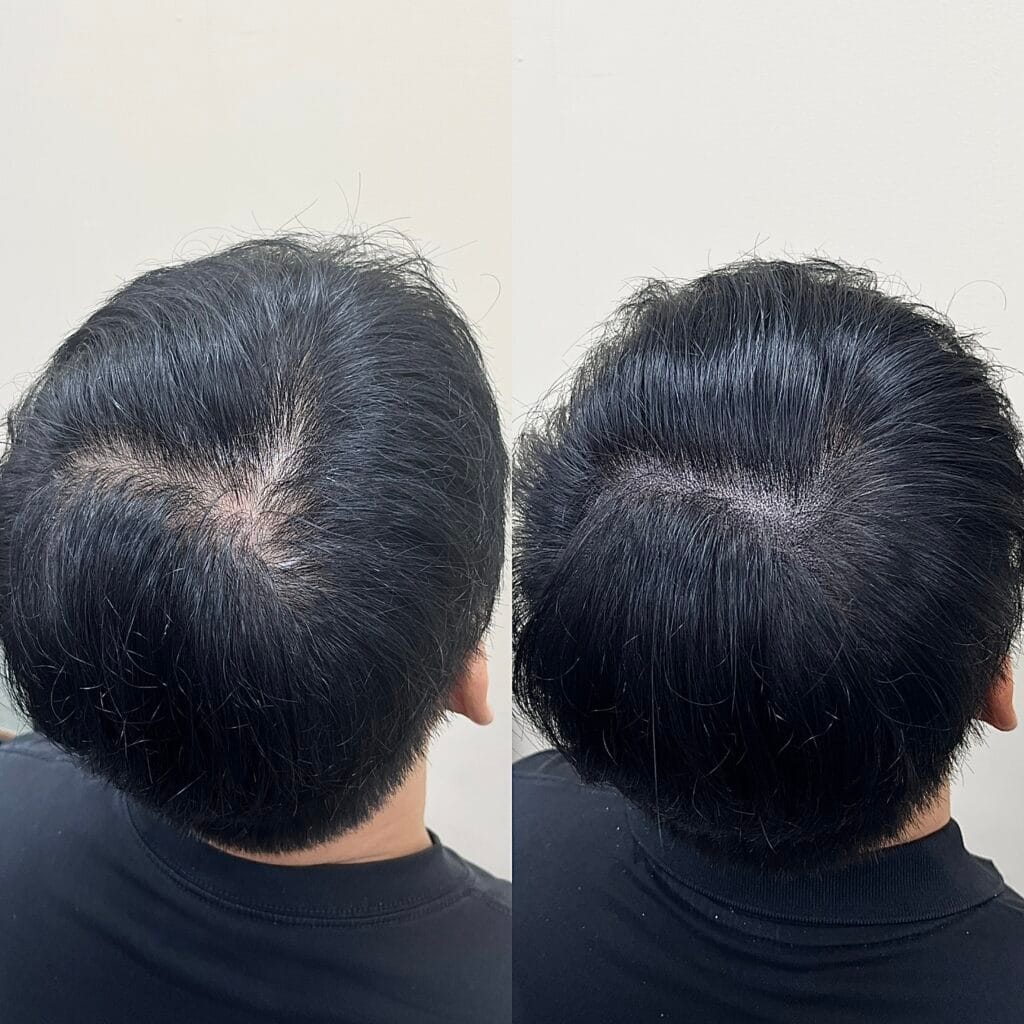 남성 정수리 두피문신 시술 전후 비교, 가마 부위 밀도 변화