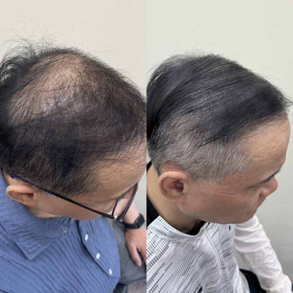 흰머리가 섞인 옆쪽 헤어라인의 시술 전후 비교