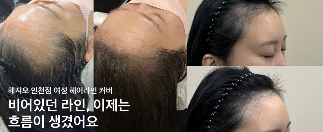 앞머리·헤어라인이 비어 보일 때, 가릴 수 있는 방법