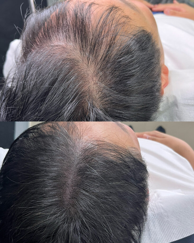 3차 시술 전후로 달라진 가마 중심부의 밀도