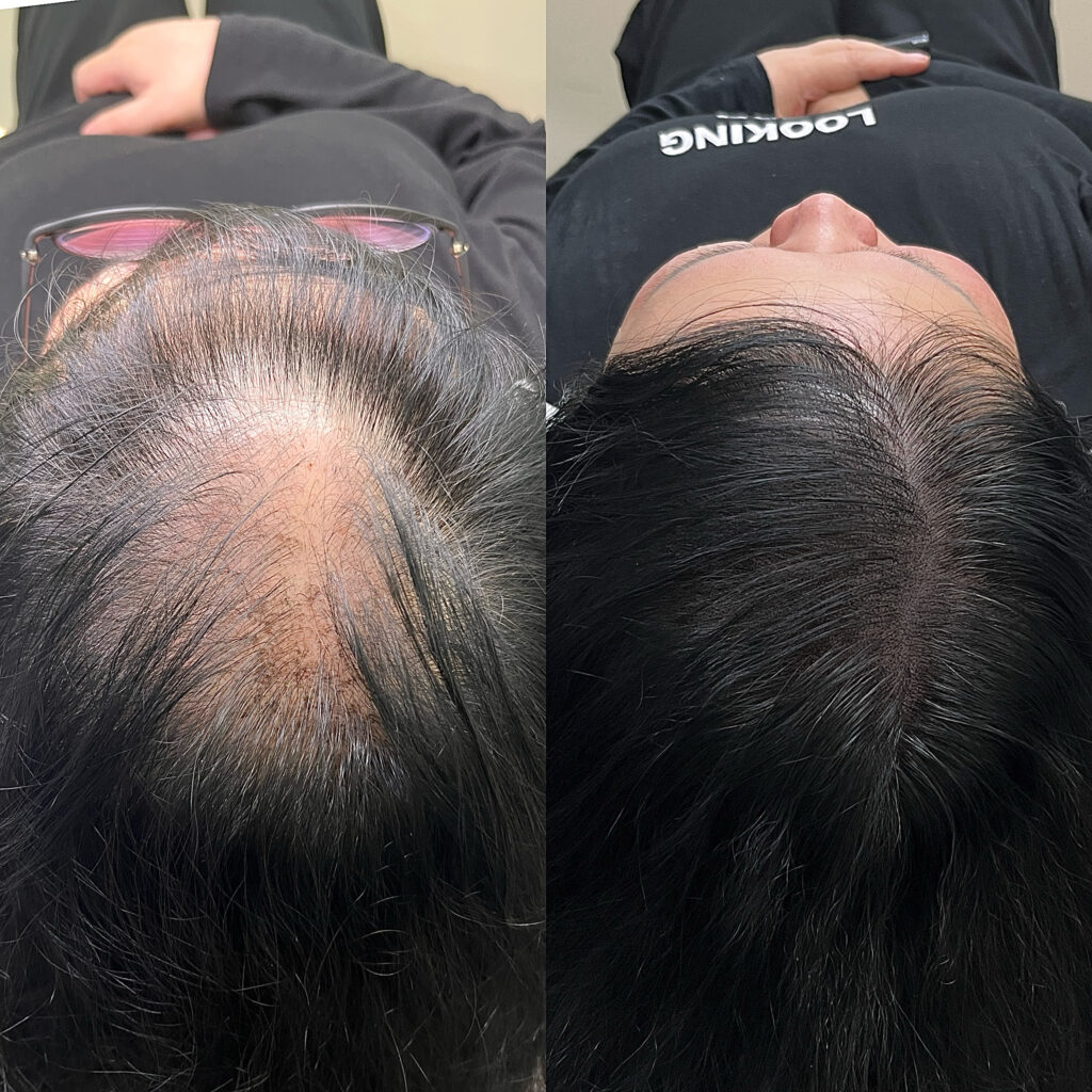 회차를 나눠 진행한 정수리 두피문신의 시작과 마무리 비교